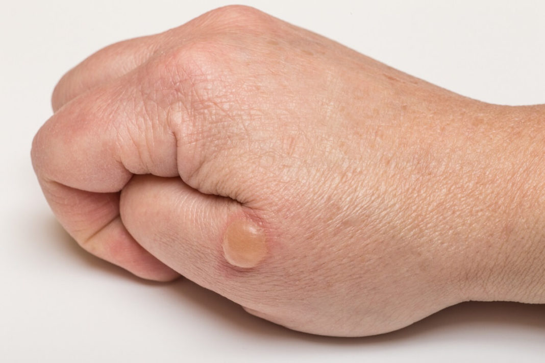 Brandblase aufstechen? Lieber nicht! So die Brandblase behandeln