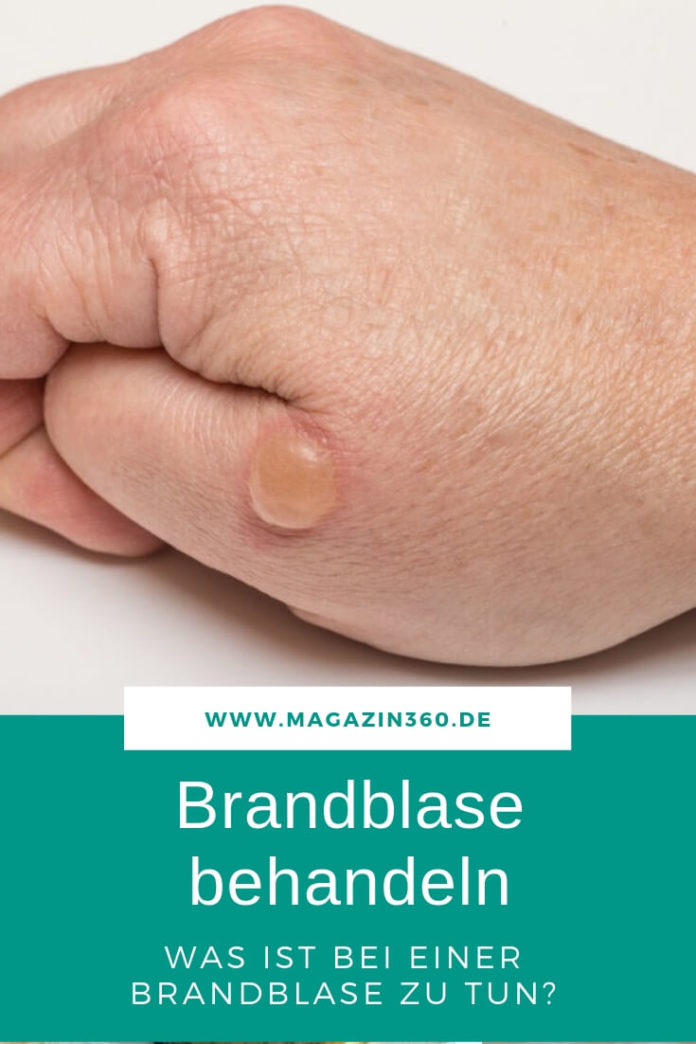 Brandblase aufstechen? Lieber nicht! - So die Brandblase behandeln
