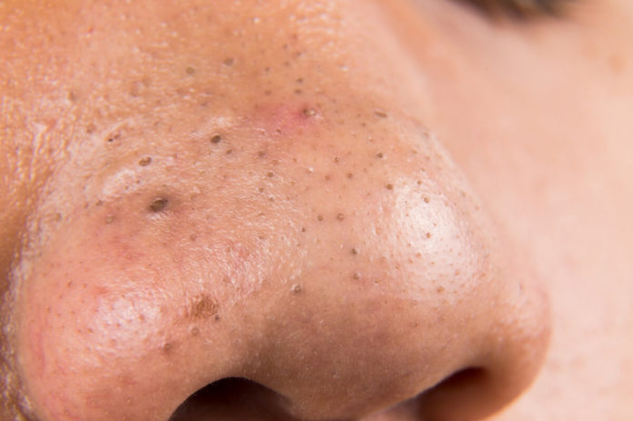 Mitesser befinden sich häufig im Gesicht, sehr oft auf der Nase - Wir geben Tipps gegen Mitesser