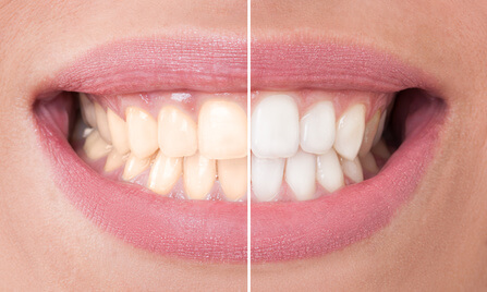Bleaching Vorher Nachher - So wirkt die Zahnaufhellung