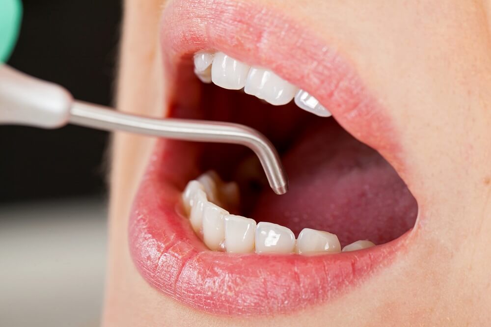 Die Air Flow Zahnreinigung befreit die Oberfläche der Zähne von Belägen und bietet sich vor einem Bleaching an